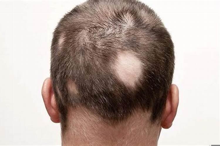 梦到自己头发秃了一块什么意思